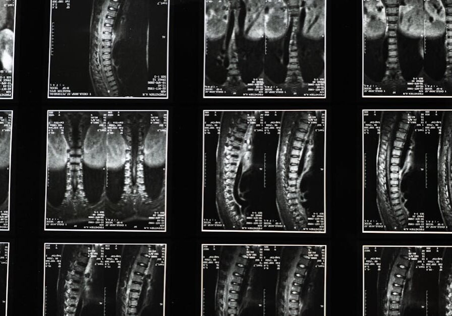 spinal cord injury compensation