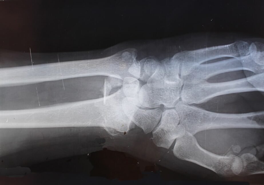 spinal injury lawyer